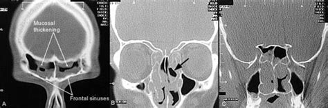 Radiologic Imaging In The Management Of Sinusitis Aafp