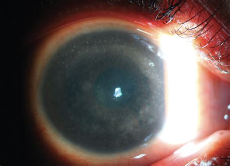 Acanthamoeba Keratitis Ring Infiltrate