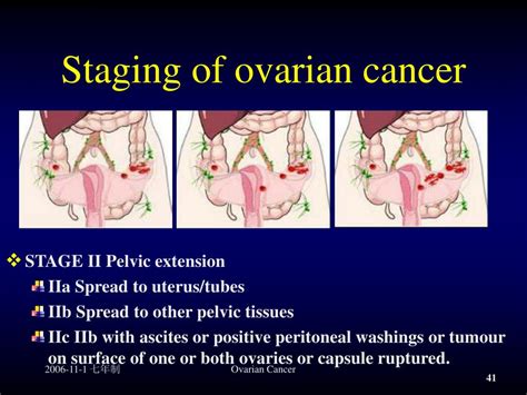 Ppt Ovarian Cancer Powerpoint Presentation Free Download Id968652