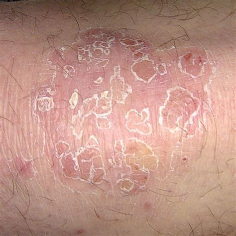 Psoriasis And Tattoos Is The Köbner Phenomenon Becoming A Problem