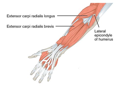 Extensor Carpi Radialis Tenosynovitis