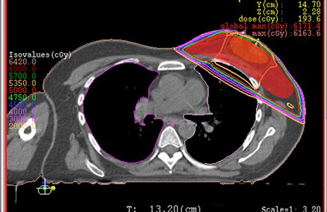 Cáncer de Mama Radioterapia HM