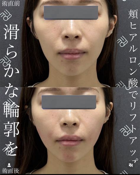 頬のコケヒアルロン酸保存版】施術直後 Emmo Face Clinic