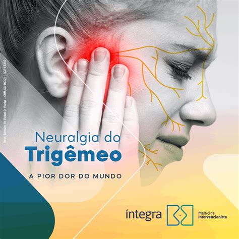 Neuralgia Do Trigêmeo Tratamento - Neuralgia Do Trigemeo Cid - BRAINCP