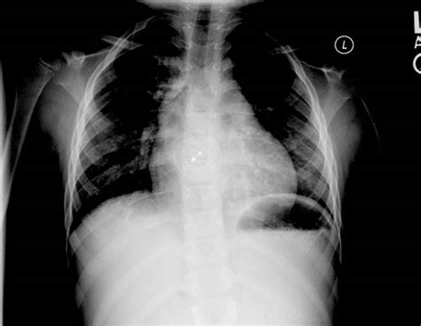 Atrial septal defect chest x ray - wikidoc