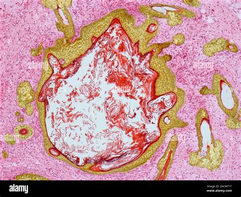 Dermoid Ovarian Cyst Light Micrograph Of A Section Through An Ovary