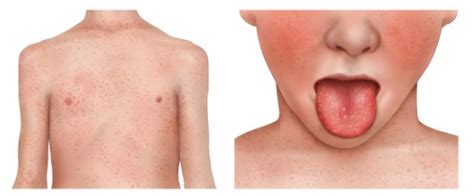 Group A Strep And Scarlet Fever West Yorkshire Healthier Together