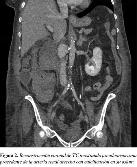 Pseudoaneurisma De Arteria Renal Principal Asociado A Fistula Cecal