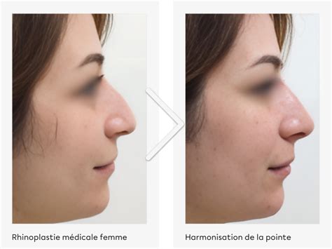 Rhinoplastie médicale sans chirurgie Injections dacide hyaluronique nez