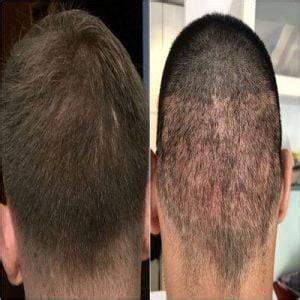 Scarless Hair Transplant In Islamabad Rawalpindi Pakistan Skn Clinic