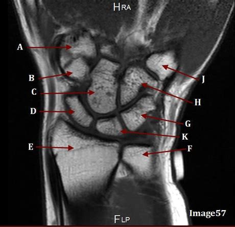 Mri Quiz Anatomy Upper Extremity Flashcards Quizlet