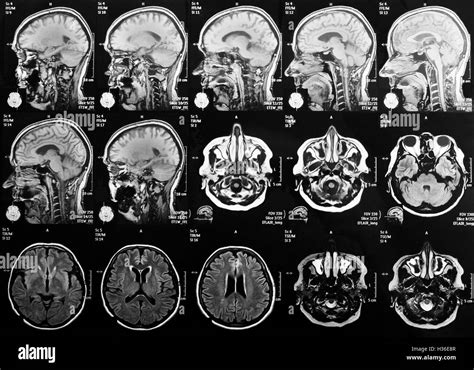 Resonancia Magnetica Cerebro Fotografías E Imágenes De Alta Resolución