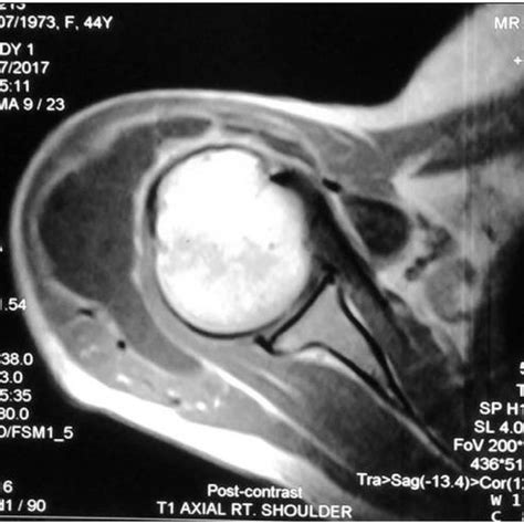 a & 3b: Coronal T2-weighted MRI images of right shoulder showing ...