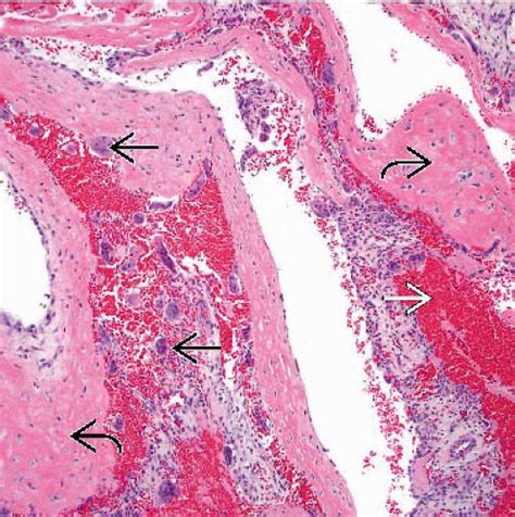 Bone Cyst Histology