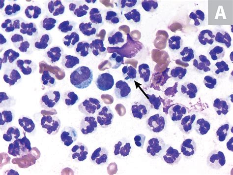 Effusion Cytology Clinician S Brief