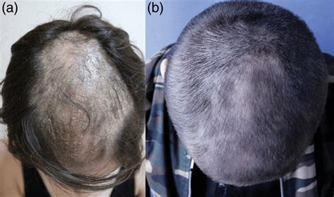 A An Erythematous Scaly Plaque With Diffuse Alopecia B A Dramatic