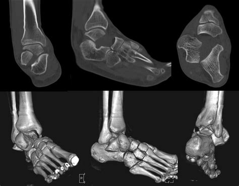 Coronal Plane Talar Body Fracture Associated With Subtalar And