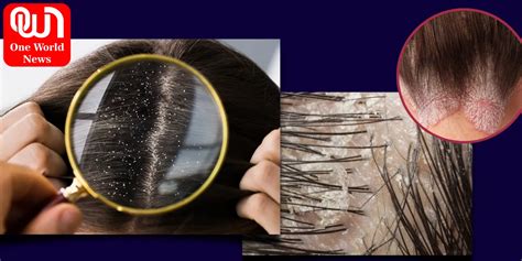 Scalp Conditions: Pictures, Causes, and Treatments