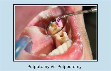 Key Difference Between Pulpotomy And Pulpectomy Oral Health Line