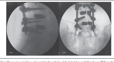 Figure 2 From A Retrospective Review Of Spinal Radiofrequency Neurotomy