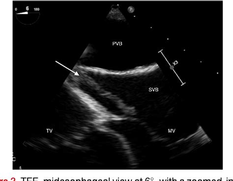 Figure 3 From Infective Endocarditis Of The Systemic Venous Baffle