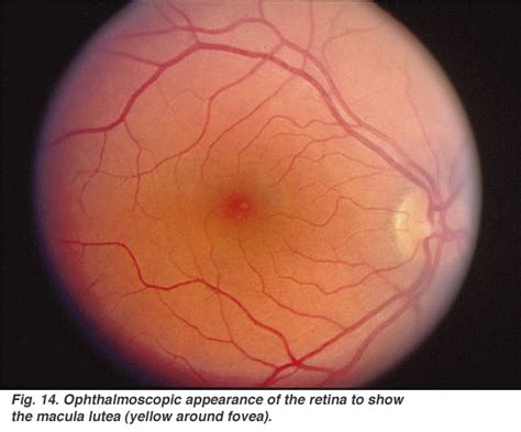 pathology - Explanation of the ‘cherry red spot' in Tay Sachs disease ...