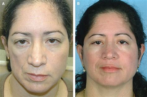 Applications Of Porcine Dermal Collagen Enduragen In Facial Plastic