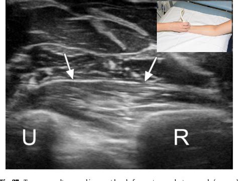 Figure 2 From Ultrasound Of The Elbow With Emphasis On Detailed