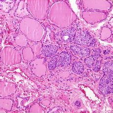 Case An Ordinary Focus Of Solid Cell Nests Found Incidentally In A