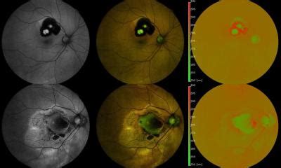 Neue Bildgebung Hilft Bei Uveitis Diagnose Healthcare In Europe