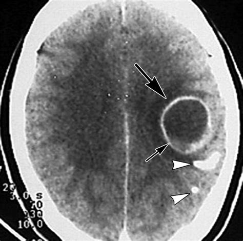 Neurocysticercosis Radiologic Pathologic Correlation Radiographics