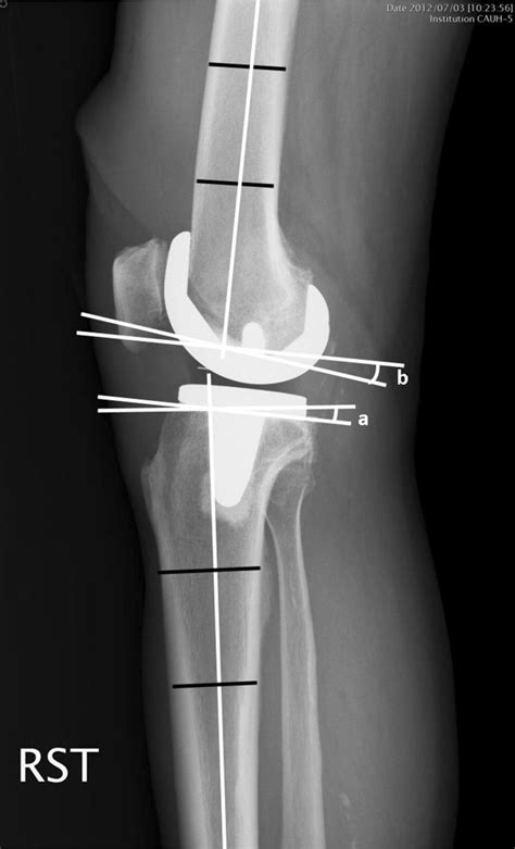 Tibial Posterior Slope Angle A Was Defined As The Angle Between The