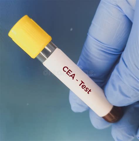 Blood Sample for CEA (carcinoembryonic Antigen) Test, Tumor Marker for ...