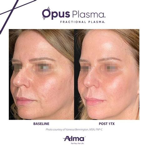 Opus Plasma Skin Tightening Gallery The Beauty Spot In Boulder Colorado