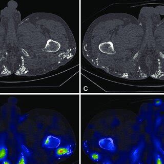 A And B Baseline Single Photon Emission Tomography Computed