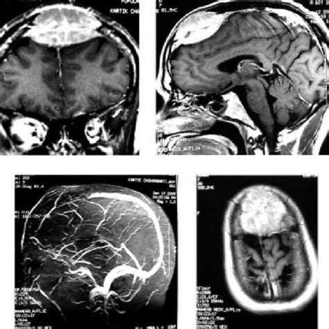 Mri Of Brain Shows Contrast Enhanced Lesions In Different Views And Mrv