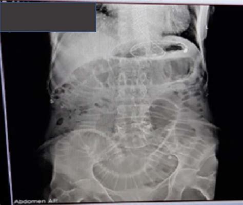 Plain Abdominal X Ray Showing Dilated Small Bowel Loops With Visible Download Scientific