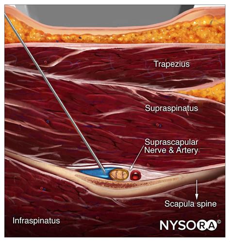 Ultrasound Pain Block Tip Of The Week Suprascapular Nerve Block Nysora