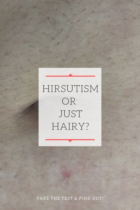 Hirsutism Or Just Hairy Hirsutism Quiz Hirsutism Cushings