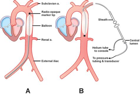 Intraoperative Intra Aortic Balloon Pump Insertion Step By Step Mmcts