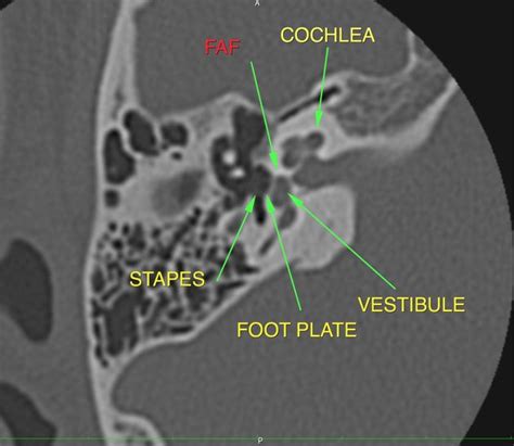 Ct Temporal Bone Anatomy - Anatomy Reading Source