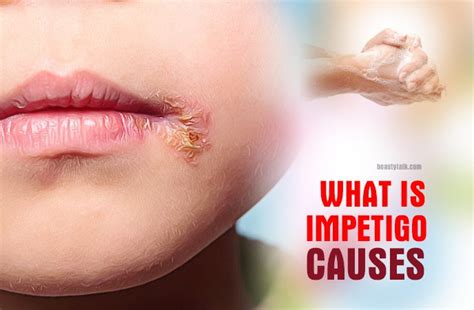 What Is Impetigo Causes Symptoms Treatment Prevention