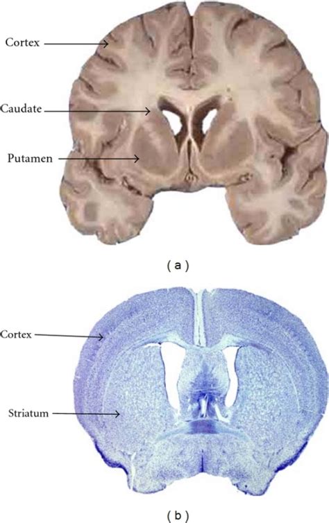 A Coronal Section Of A Human Brain Showing The Cortex Open I