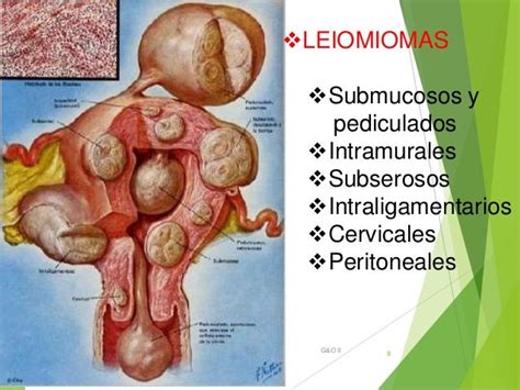 Tumores Benignos De útero Leimiomas Fibromas Endometriosis Y Adeno