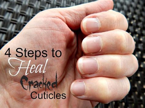 Fantastic Info About How To Cure Bad Cuticles Waterask