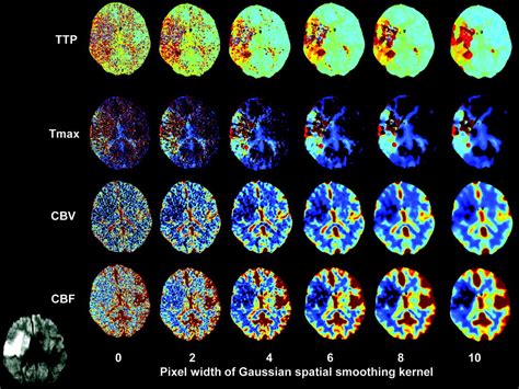 Cerebral Blood Flow Is The Optimal CT Perfusion Parameter For Assessing