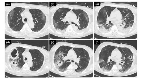 Necrotizing pneumonia due to Pseudomonas aeruginosa secondary to severe ...