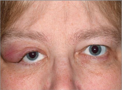 Figure 1 From Unilateral Eyelid Swelling With Submandibular Lymph Node