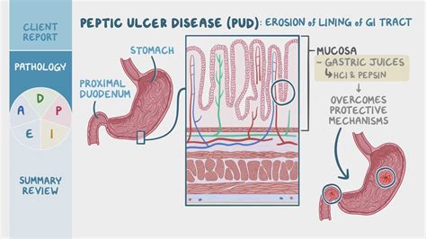 Adpie Pyloric Stenosis Osmosis Hot Sex Picture