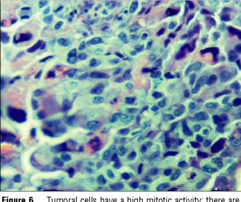 Figure 6 From Cutaneous And Inguinal Lymph Nodes Metastases Disseminated From An Endometrial